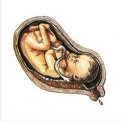 羊水多少才算正常,孕中期羊水多少才算少