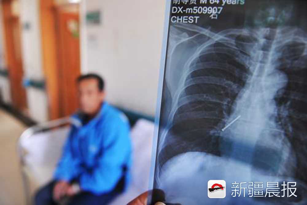 乌市一装修工口含铆钉作业张口说话4厘米长钉子滑进气管入肺