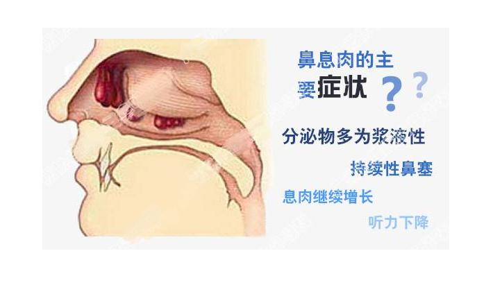鼻息肉学名,鼻息肉科普小视频40秒