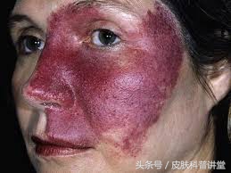 治疗鲜红斑痣胎记最好的医院,鲜红斑痣好治还是红胎记好治