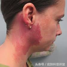 鲜红斑痣和新生儿红胎记区别,激光染料治疗网状鲜红斑痣的效果