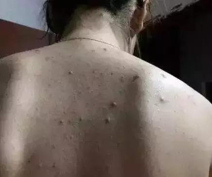 背后长很多小米粒该怎么办,背后长了很多的小米粒用什么药