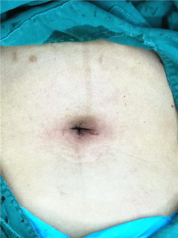 淄博莲池妇婴医院完成两例经脐单孔腹腔镜手术