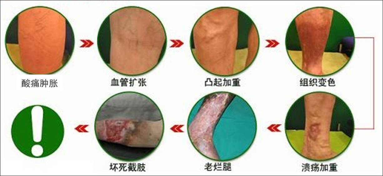 下肢静脉曲张的症状及治疗方法,下肢静脉轻度曲张穿几级弹力袜