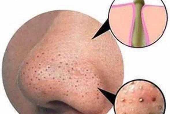 如何去黑头收缩毛孔小妙招,实用去黑头收缩毛孔小妙招