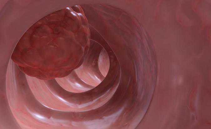 便秘折磨15年,吃不下,拉不出!原来肚里长个10斤大“皮球”