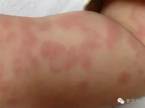 新生儿宝宝红疹子怎么引起的,新生儿皮肤起红疹子怎么办