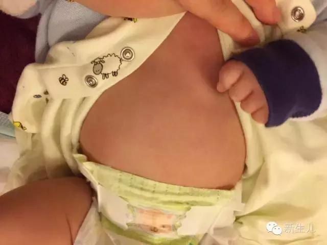 新生儿:婴儿皮肤起红疹?教你如何护理宝宝娇嫩的皮肤