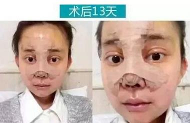 重庆女孩自曝整容日记，迷教主花百万变形为Angelababy