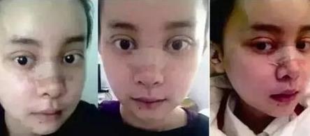 重庆女孩自曝整容日记，迷教主花百万变形为Angelababy