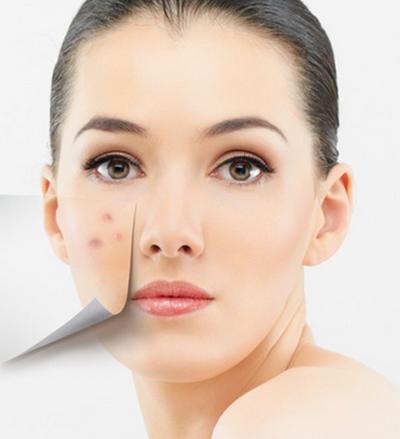 油性皮肤如何去痘痘这些方法你值得一试