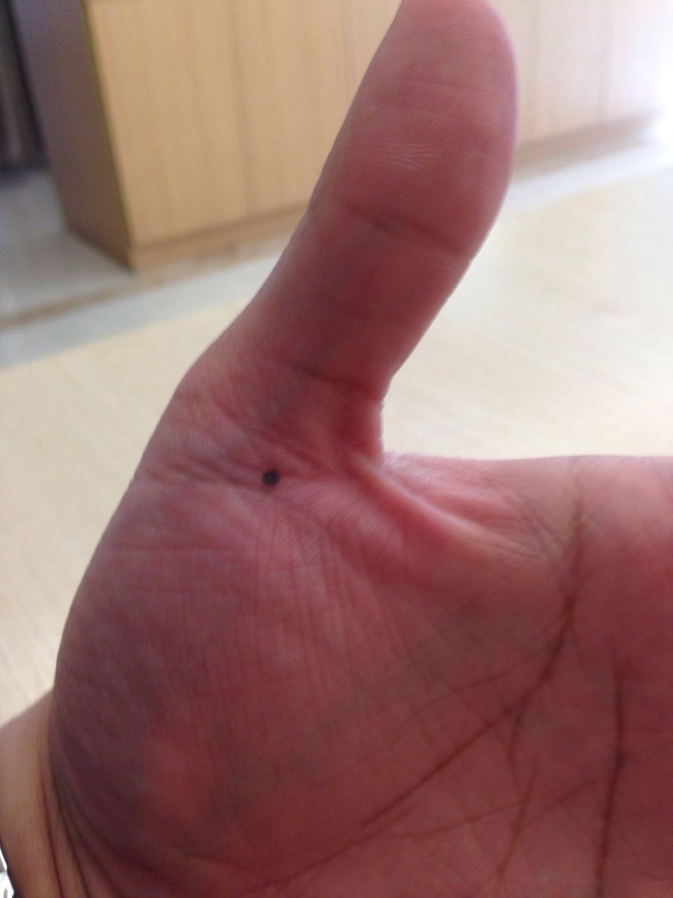 手指腱鞘炎怎么治,膏药能治腱鞘炎吗