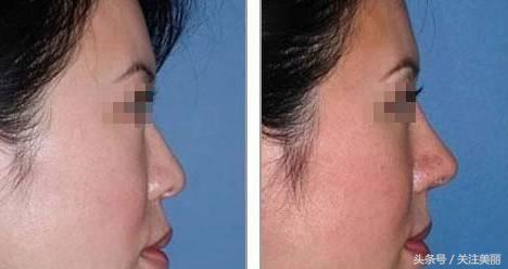 玻尿酸有什么效果呢,玻尿酸对皱纹有疗效吗