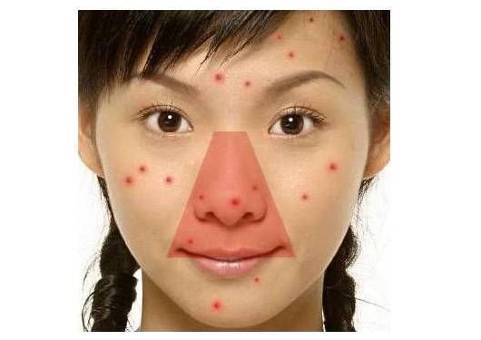 挤完痘痘后皮肤护理视频,挤完痘痘修复视频