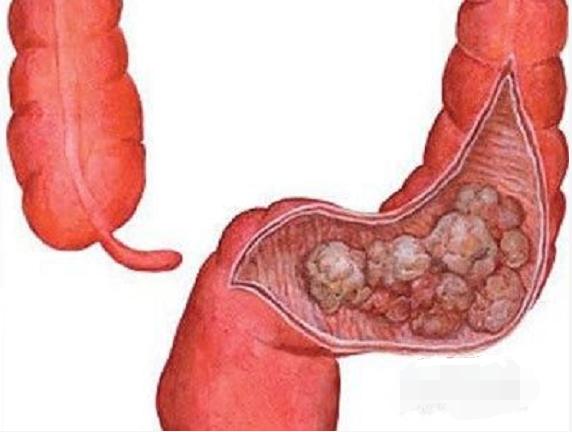 生姜贴肚脐治疗便秘的正确方法,推荐几款治疗便秘的食谱