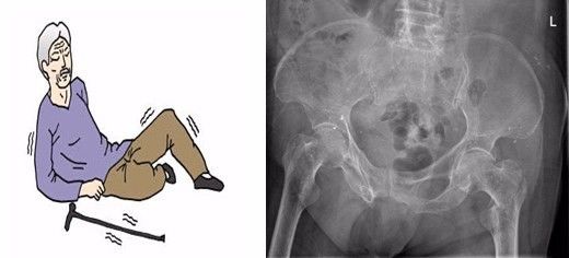 粗隆间骨折做pfna,pfna手术好处