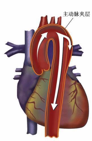 主动脉夹层心血管爆裂,心血管主动脉夹层早期症状
