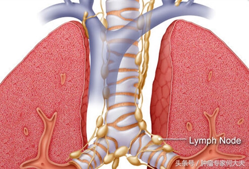 被查出肺癌一期,80岁老人肺癌晚期吃中药有效果吗