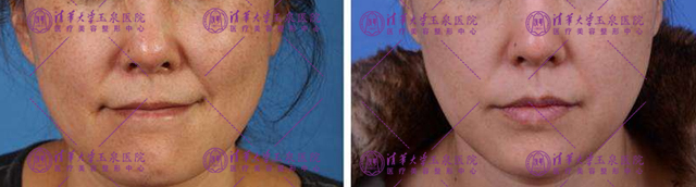 瓷娃娃美白过程,白瓷娃娃美白