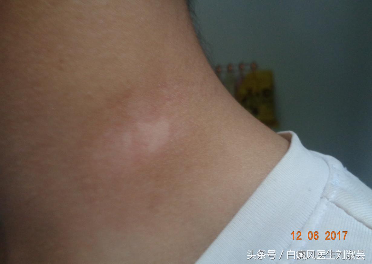 太阳晒后出现白癜风怎么修复,太阳晒伤会得白癜风吗