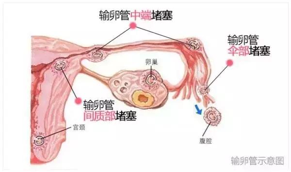 输卵管堵塞宫外孕后还敢怀孕吗,多囊加输卵管堵塞怀孕几率多大