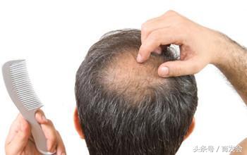 章光101脂溢性脱发效果怎么样,脂溢性脱发中医能治愈多久有效果