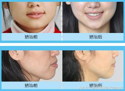 牙齿不齐矫正牙齿的最佳年龄,牙齿排列不齐有必要矫正吗