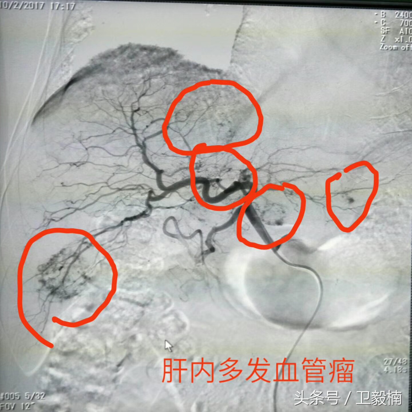 微创介入科一卫毅楠,卫毅楠运城介入治疗