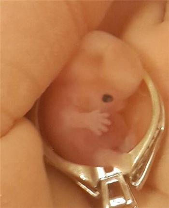 痛经，例假不规律，直到怀孩子流产后她才真正知道了原因