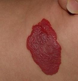 丢失孩子出生时脖子后面有胎记,婴儿出生胎记用不用去除