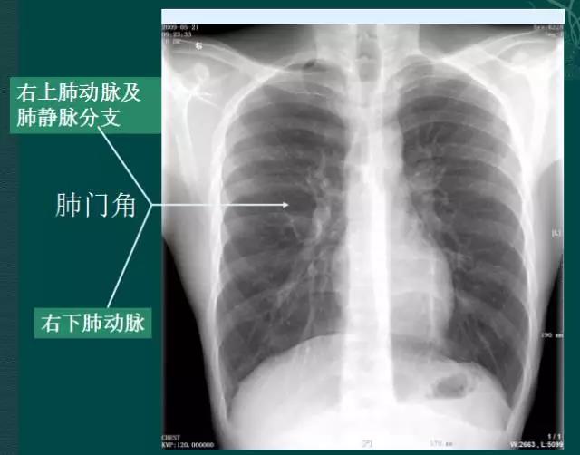 读完该文,让你学会如何看胸片