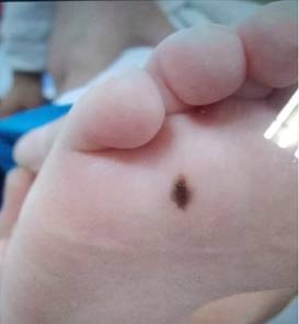 身上的黑痣什么情况下要去检查,身上的黑痣要不要去除