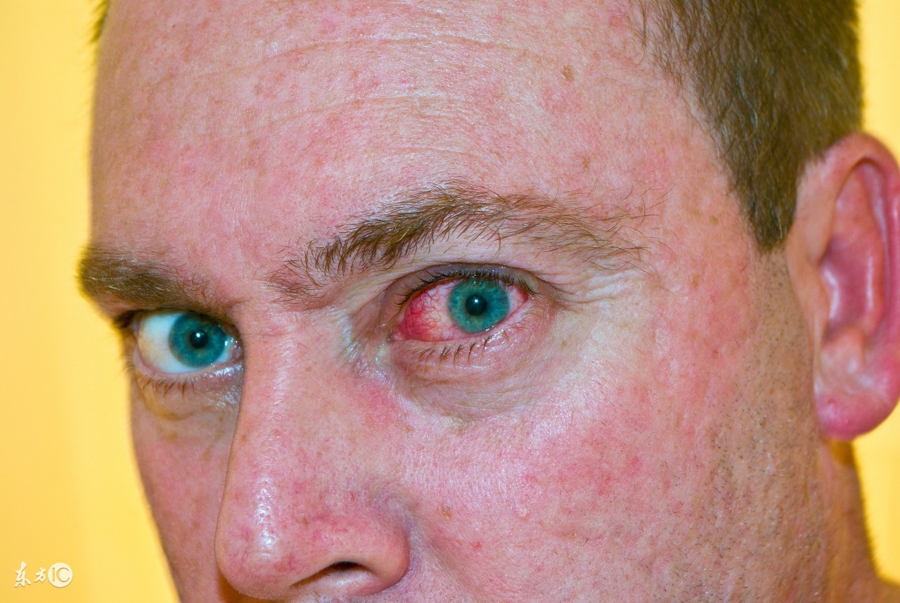 一激动就脸上长红疹,药物引起的脸上红血丝要怎么治