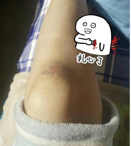 膝盖容易撞到淤青,膝盖经常磕伤怎么回事