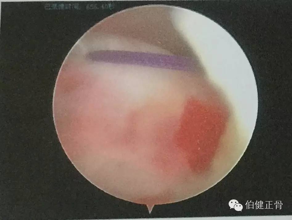 关节内外、经骨骺/不经骨骺单隧道纽扣技术治疗小儿前交叉韧带止点撕脱骨折经验介绍