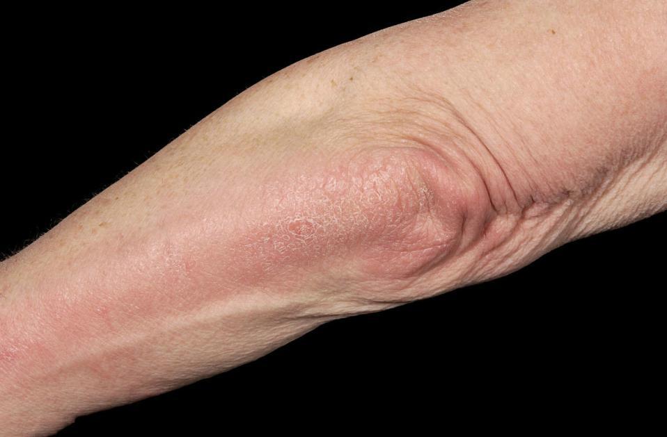 关节型银屑病的鉴别诊断,关节病性银屑病诊断标准