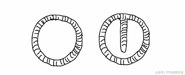 图解宫内节育器放置流程