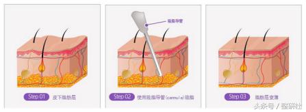 什么身材适合做腹壁整形,腹壁整形术前后恢复效果图