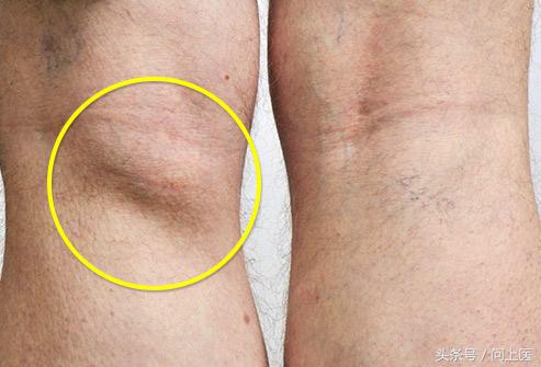 运动后膝盖疼痛的原因和解决方法,跑步后膝盖疼痛的原因和解决方法