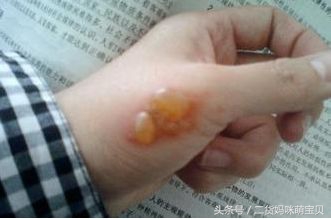 小孩子烫伤了怎么安慰她妈妈,孩子烫伤了怎么处理好得快