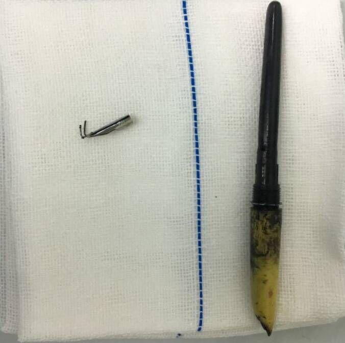 眼部穿透异物取出手术后多久恢复,眼二科独立手术成功案例