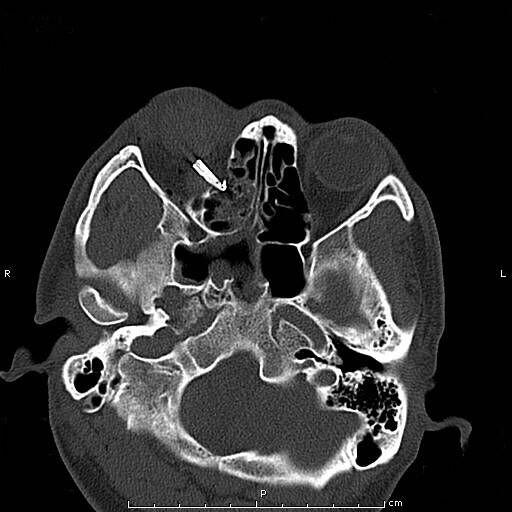 眼部穿透异物取出手术后多久恢复,眼二科独立手术成功案例
