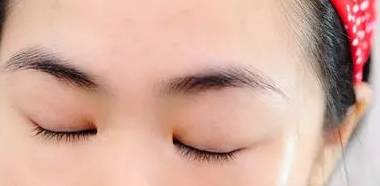 色素型黑眼圈加眼袋怎么解决,戳到眼睛眼白一块血块怎么办