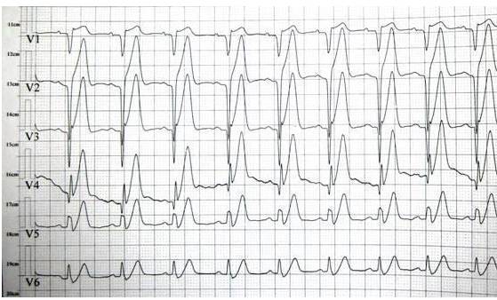 t波高尖st段正常怎么办,t波高尖是怎么引起的