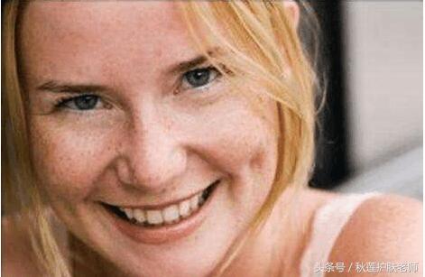 褐斑祛斑,褐斑祛斑最有效方法