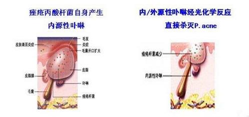 战痘整体思路,战痘第一步教学视频