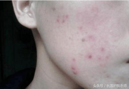 棕色痘印变成红色痘印,灰色痘印变成红色痘印