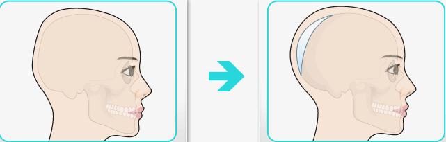 后脑勺凸起头型不好看如何矫正,什么头型让后脑勺凸起来
