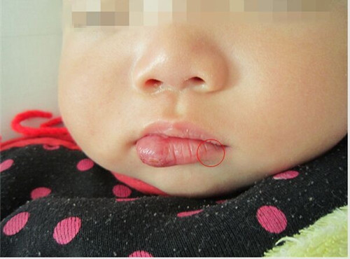 海绵状血管瘤是像海绵样的吗,海绵状血管瘤怎么形成的