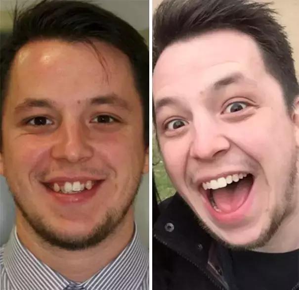 后悔整牙和不后悔整牙,整牙一般整到什么样就可以了